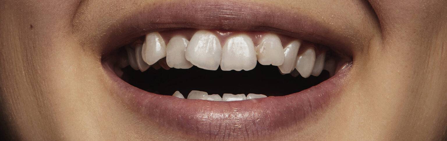 Cómo tratar el apiñamiento dental inferior - Clínica de ortodoncia Dra ...