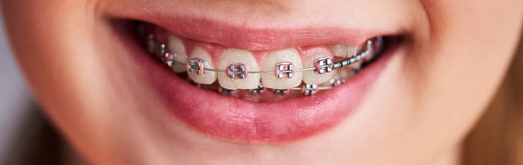 Brackets-metálicos-vs-estéticos-cuál-es-la-mejor-opción
