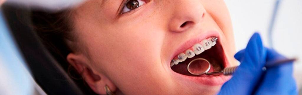 Mentonera-en-Ortodoncia-Usos-y-beneficios-para-la-sonrisa