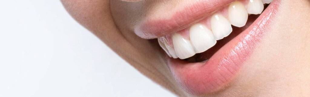 ¿Se-puede-poner-ortodoncia-para-corregir-un-solo-diente