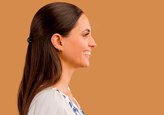 sobremordida aumentada